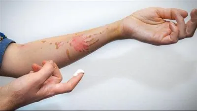 علاج حروق الزيت: خطوات مهمة للتخفيف من الألم وتعزيز عملية الشفاء