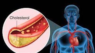 ارتفاع الكوليسترول..أعرف الأسباب والأعراض والعلاج