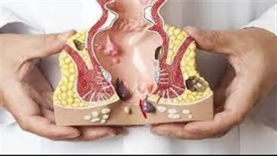 البواسير (Hemorrhoids)... الأسباب والأعراض ووالعلاج