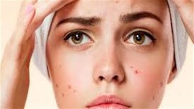 حب الشباب... مشكلة يعاني منها غالبية المراهقين