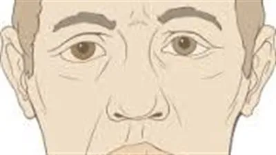 تضرر العصب السابع..كل ما تريد معرفته