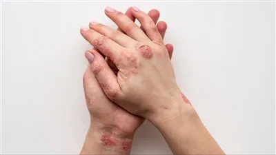 مرض السل الجلدي: تعرف على التشخيص والعلاج