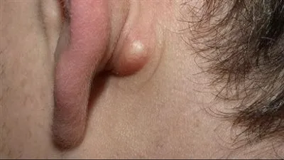ظهور ورم خلف الأذن.. فهم أسبابها وكيفية التعامل معها