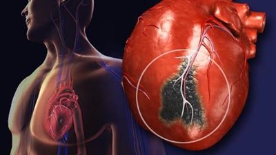 تعرف على جلطات القلب وأسبابها 