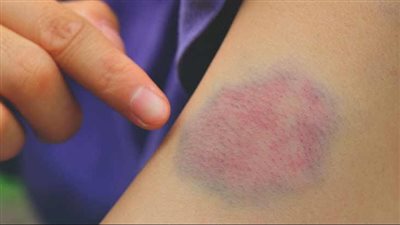  جلطات الدم: فهم المفهوم والأسباب ووسائل الوقاية 