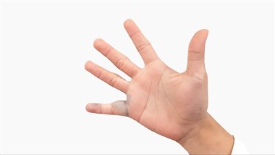  جلطات اليد: أسبابها وأعراضها وسبل الوقاية 