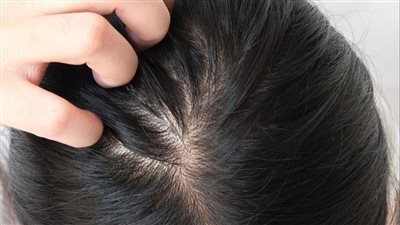  التهاب فروة الرأس: أسبابه وكيفية التعامل معه 