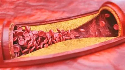 مرض تصلب الشرايين: التحديات وسبل الوقاية 