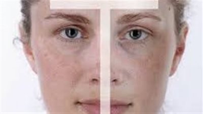 ماهي الشرة المختلطة.. وكيفية العناية بها والروتين المناسب لها 