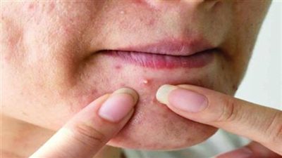 حبوب البشرة وأفضل الطرق لعلاجها