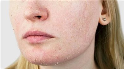 التخلص من جفاف الوجه خلال اسبوع..وطريقة القضاء على قشور الوجه الشتوية