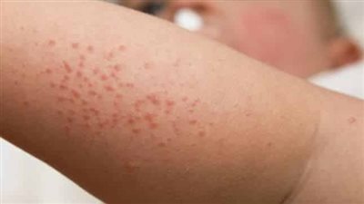 حساسية الفاكهة: عندما يصبح اللذيذ مصدرًا للتحديات الصحية 