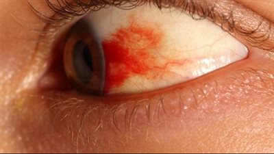 ظهور بقع دم في العين.. الأسباب وطرق الوقاية