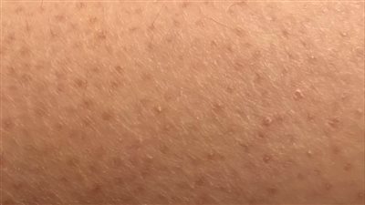 جلد الوزة: أسبابه وكيفية الوقاية والعلاج