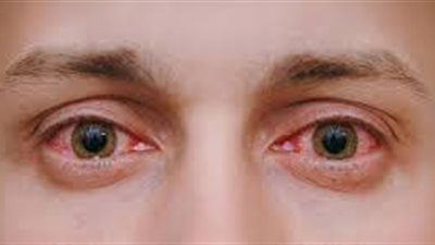 احمرار العينين.. من الأسباب إلى طرق العلاج
