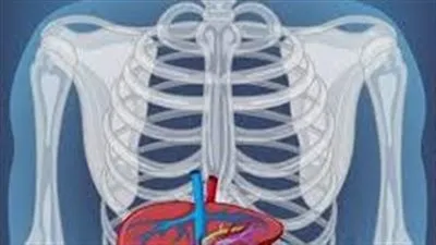 التهاب المرارة.. حالة طبية خطيرة قد تتطلب تدخلًا جراحيًا