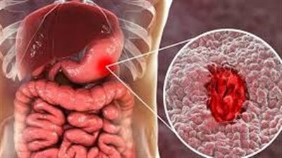 قرحة المعدة: كيف تنشأ؟ وما علاجها؟ ( تفاصيل )