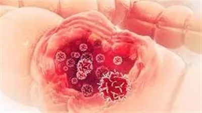 الأسباب المجهولة لسرطان القولون: فك شفرة التحليل والتوعية