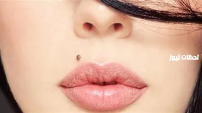 حبة الخال.. هل هي من علامات الجمال أم مرض جلدي؟