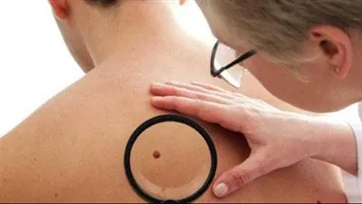 أعراض السرطان بشكل عام..الإشارات الحيوية التي يجب مراقبتها للحفاظ على الصحة الشاملة