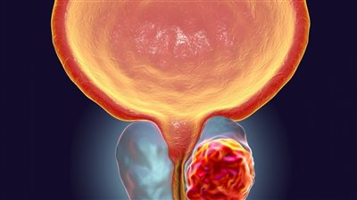 سرطان البروستاتا: معلومات أساسية