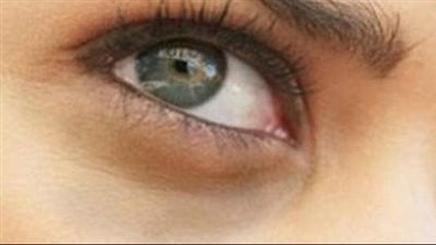 فهم وعلاج الهالات السوداء.. استكشاف الأسباب والحلول للتخلص من سواد تحت العينين