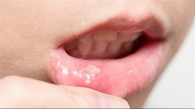 أسباب ظهور الحبوب داخل الفم.. فحص الأسباب وكيفية التعامل بها بشكل فعّال
