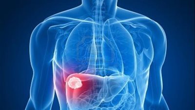 تليف الكبد.. تعرف على السبب الرئيسي 