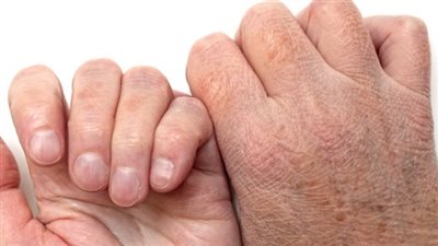 أستاذ جلدية يقدم روشتة للتخلص من تشققات الشتاء (فيديو)