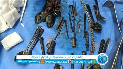 صدق أو لا تصدق.. استخراج نصف دستة معالق وموس حلاقة وأنسيال ومسامير من معدة مريض بالمنوفية