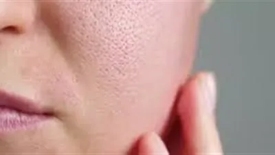 إليكِ طرق علاج المسام الواسعة المفتوحة طبيًا