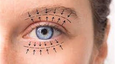  ترهل جفون العينين.. من الاسباب إلى العلاج