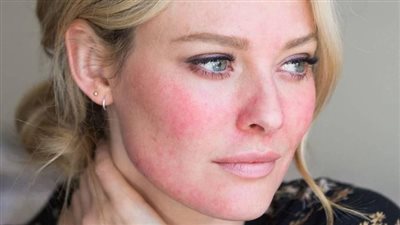 كيف تعتني ببشرتك الحساسة في ظل الشتاء والجو القارس ؟