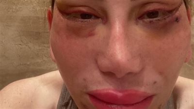 ريهام سعيد تنشر صورًا جديدة لوجهها بعد أسبوعين من الجراحة الفاشلة