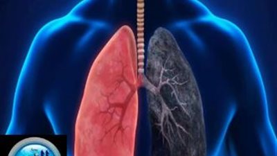 تعرف على أعراض الانسداد الرئوي