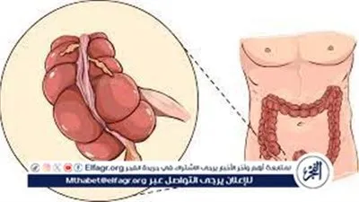 الزائدة الدودية.. تواجدها وأمراضها