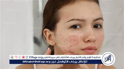 تعرف علي افضل 10 طرق للحفاظ علي بشرتك من الاصابة بحب الشباب 2024