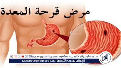  قرحة المعدة.. تعرف على أسبابها وعلاجها ووسائل الوقاية 