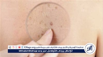 حقائق عن الليزر وسرطان الجلد: هل هناك خطر؟