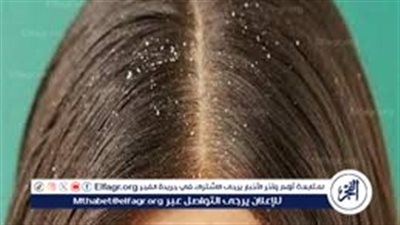 حل القشرة السحري.. وصفات من مطبخك للقضاء على القشرة نهائيا