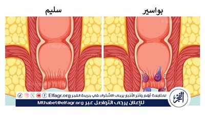 فهم البواسير: أسبابها وطرق علاجها، البواسير 