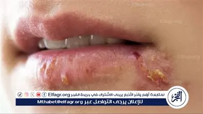 تطعيم الحزام الناري على مستوى محافظات الجمهورية.. اماكن توفر المستحضرات الحيوية 