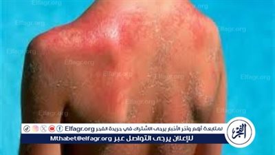 التهابات الجلد الناتجة عن التعرض لأشعة الشمس.. الأسباب والوقاية 