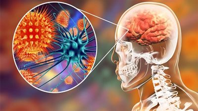 التهاب السحايا.. أسبابه وأعراضه وسبل الوقاية والعلاج