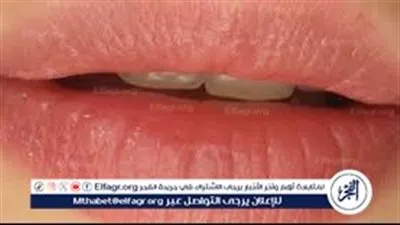 وصفة مذهلة هتخلي شفايفك مرايا من أول استعمال