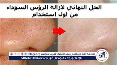 طريقة إزالة الرؤوس السوداء من الوجه في 10 دقائق فقط