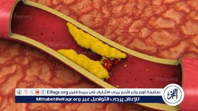استشاري قلب: مرض الكوليسترول وحش كاسر.. ويسبب الجلطات