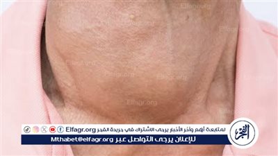 نصائح لتخفيف أعراض قصور الغدة الدرقية: كيف تتعامل مع هذه الحالة؟