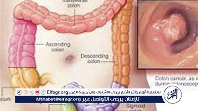 اختبار دم يكشف الإصابة بسرطان القولون