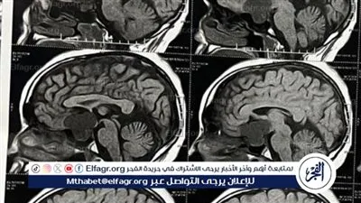 عودة الرؤية لشاب عشريني بعد استئصال ورم بالجمجمة بسوهاج